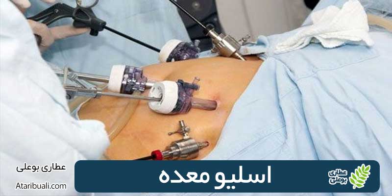 اسلیو معده
