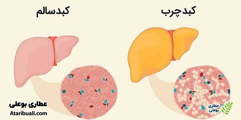 انواع کبد چرب
