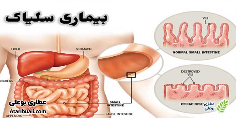 بیماری سلیاک
