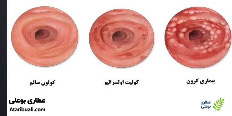 بیماری‌های التهابی روده