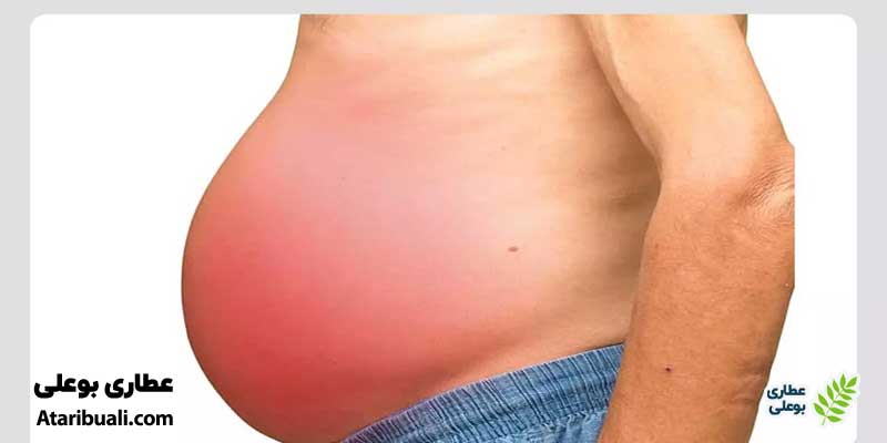 تجمع مایعات در شکم (آسیت)