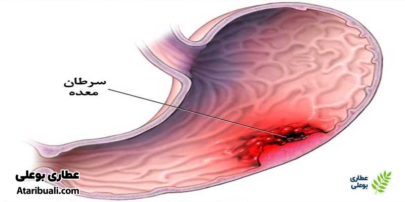 تشخیص سرطان معده یا تغییرات پیش‌سرطانی