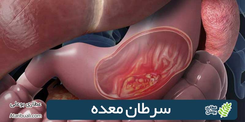 سرطان معده + 11 عوامل خطرساز آن