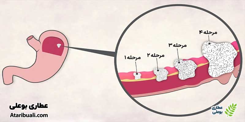 مرحله‌بندی سرطان معده