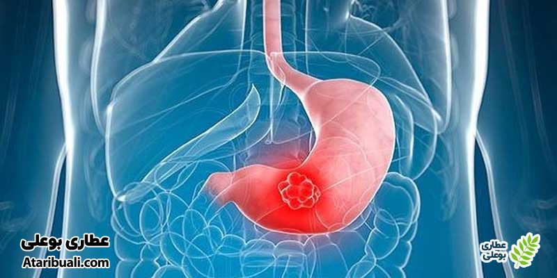 نقش بیوپسی آنتروم معده