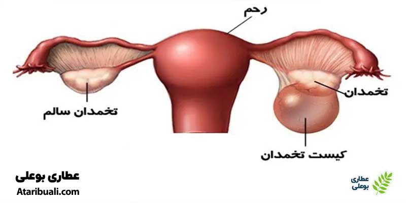 کیست تخمدان