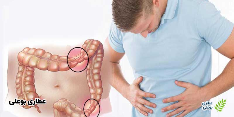 از کجا بفهمیم سندروم روده تحریک پذیر داریم