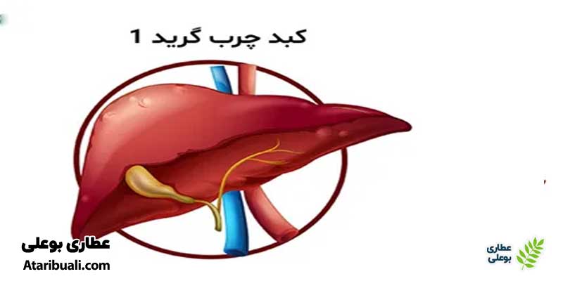 قرص برای کبد چرب گرید 1