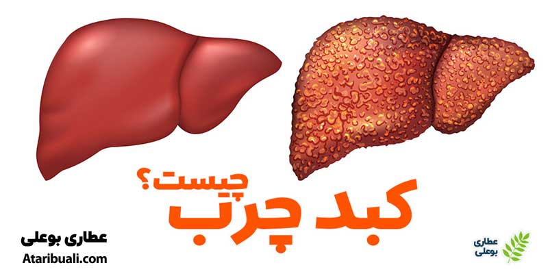 کبد چرب چیست؟