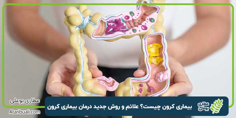 بیماری کرون چیست؟ علائم و روش جدید درمان بیماری کرون