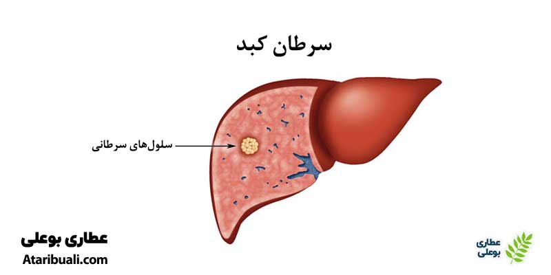 خواص کپسول لیور آکس، جلوگیری از بروز سرطان و اختلالات کبد