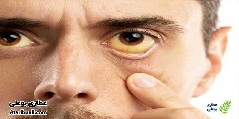 خواص کپسول نوتری دکتر اهورا، درمان آسیب‌های کبدی در بیماران مبتلا به زردی