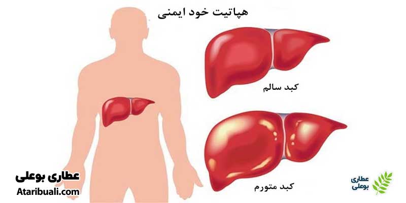 بیماری‌های خود ایمنی