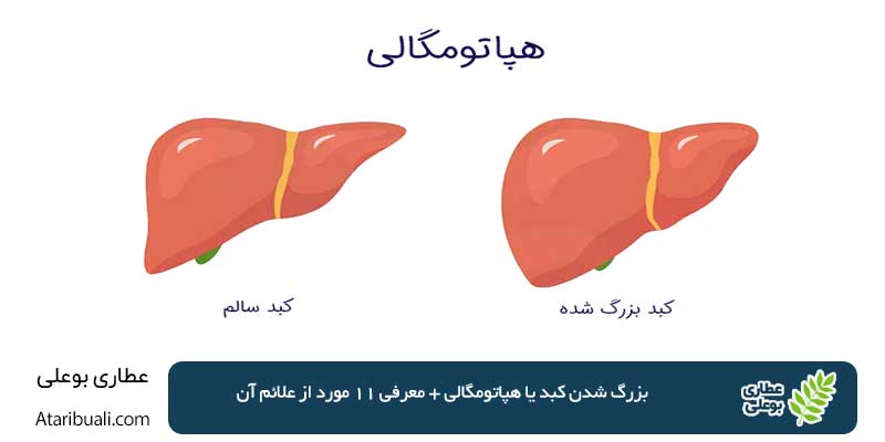 Hepatomegaly