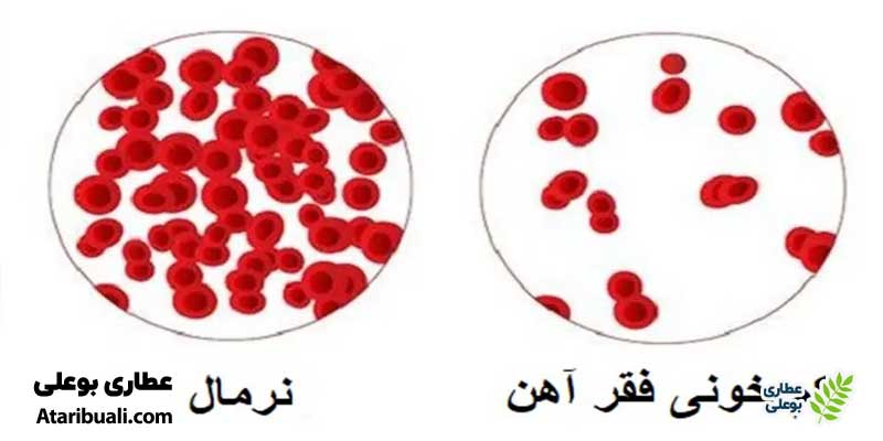 تشدید کم‌خونی ناشی از فقر آهن