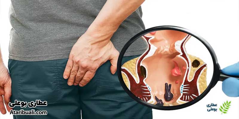 خواص قرص هپاتوهیل باریج، کمک به رفع یبوست و هموروئید