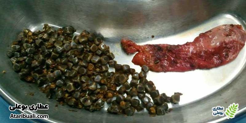 خطر سنگ صفرا یا انسداد صفراوی