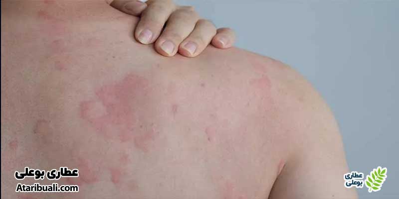 حساسیت یا آلرژی