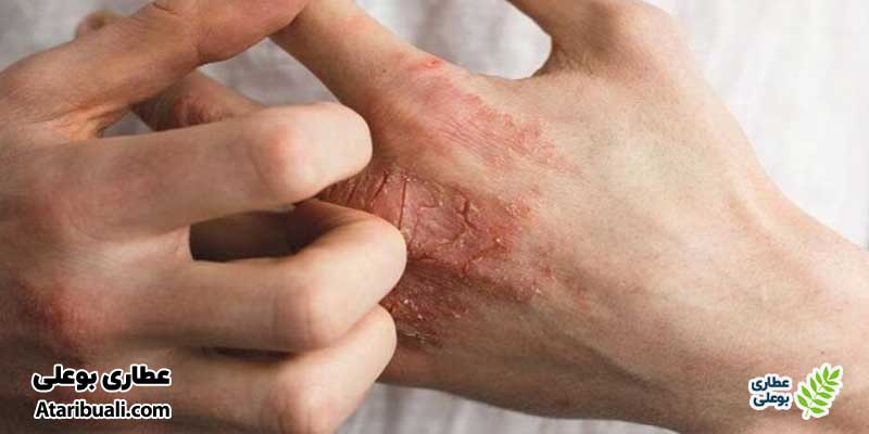 نشانههای پوستی و عروقی مرتبط با بیماریهای کبدی پیشرفته