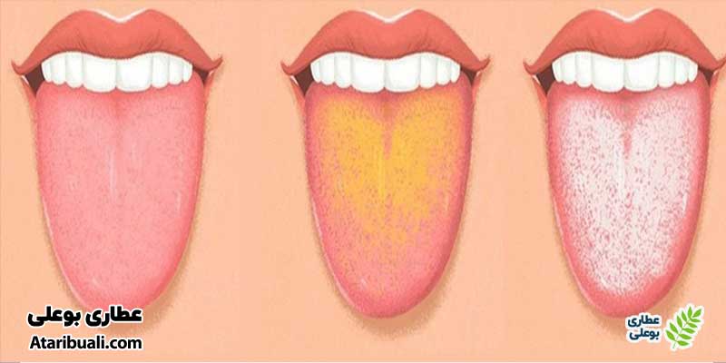 عوارض جانبی قرص بیسموت سابسیترات