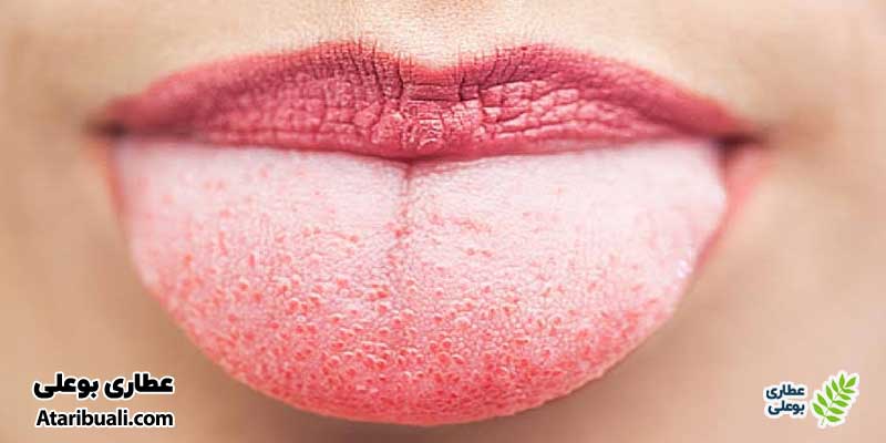دلایل سفید شدن زبان چیست؟