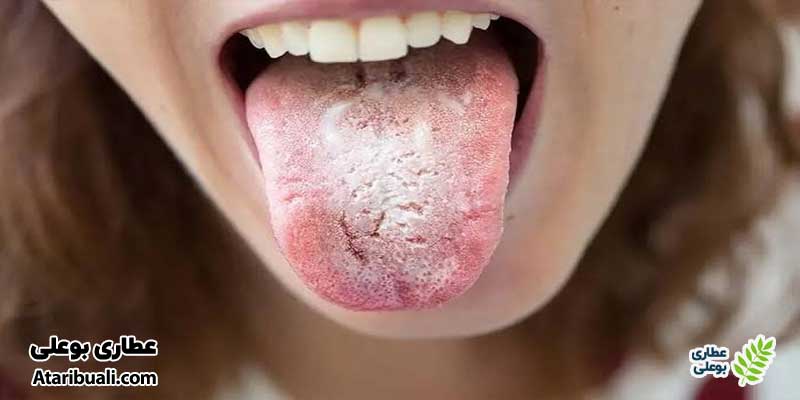 سفید شدن زبان چیست؟