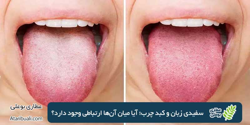 سفیدی زبان و کبد چرب؛ آیا میان آن‌ها ارتباطی وجود دارد؟